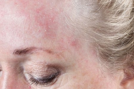 Rosacea
